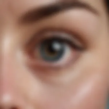 Understanding a Stye Close-up of a stye in the eye